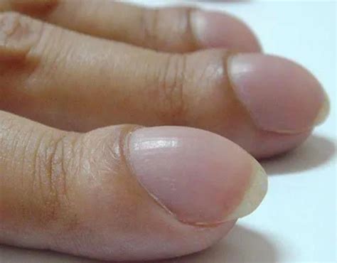 enfermedades de las uñas